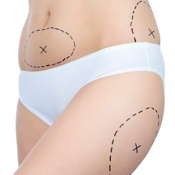 secciones dibujadas como guía en la cintura de una joven mujer marcadas antes de una sesión de Hidrolipoclasia en Girardot